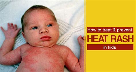 newborn heat rash prevention