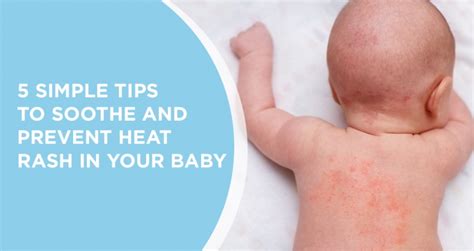 newborn heat rash when to seek medical attention