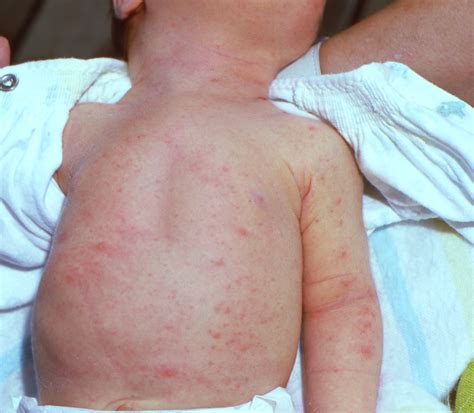 newborn skin rash