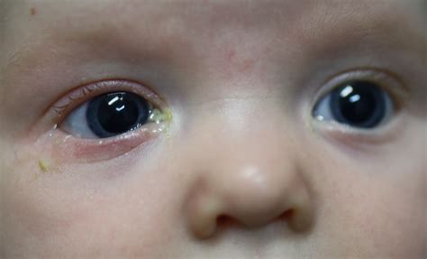 newborn tear duct obstruction symptoms