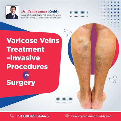 non-invasive varicose vein removal
