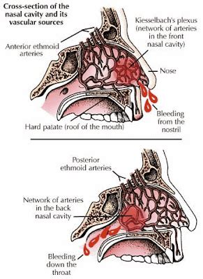 nose bleeding complications
