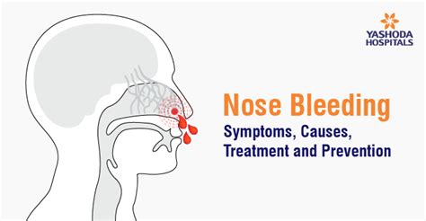 nose bleeding symptoms