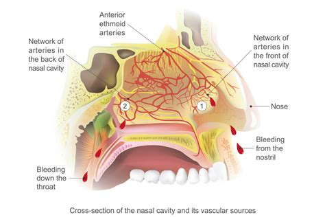 nose hemorrhage causes