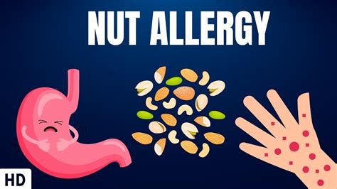 Nut allergy diagnosis