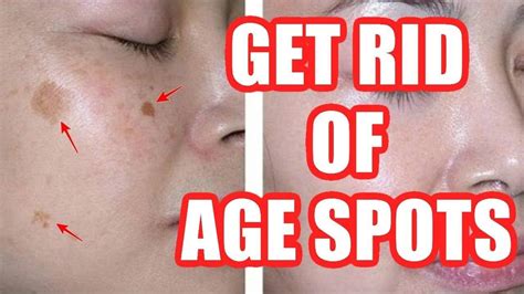 old age spots removal
