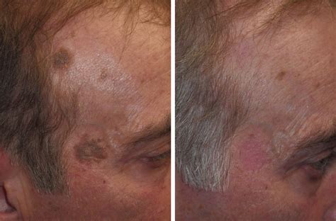 old age spots removal conclusion