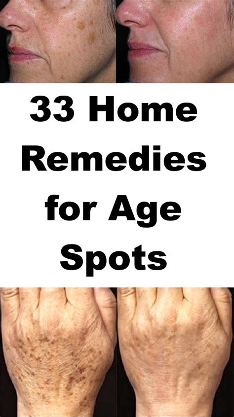 old age spots removal methods