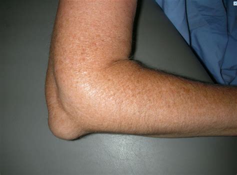 Olecranon Bursitis