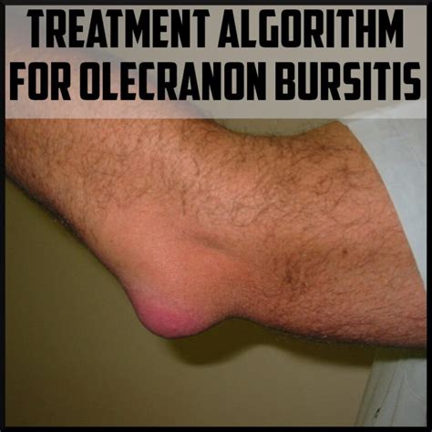 Olecranon Bursitis Treatment