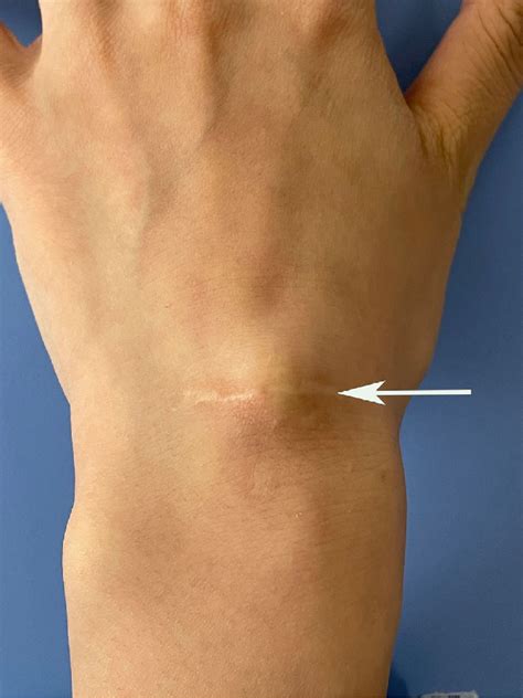 open excision of ganglion cysts