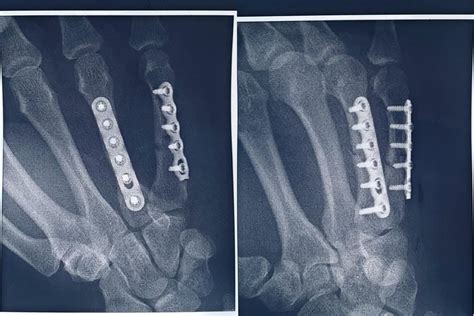 Orif Surgery