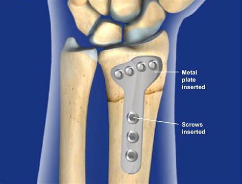ORIF Surgical Procedure
