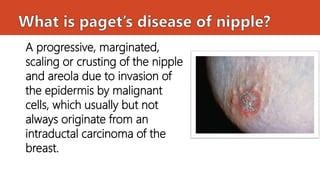 Paget's disease of the nipple