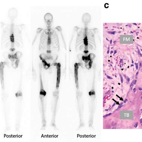 Research on Paget's disease