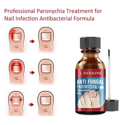paronychia healing