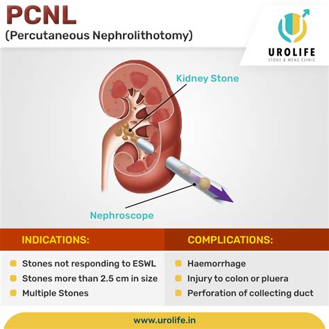 percutaneous nephrolithotomy