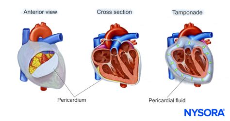 Pericardial Effusion