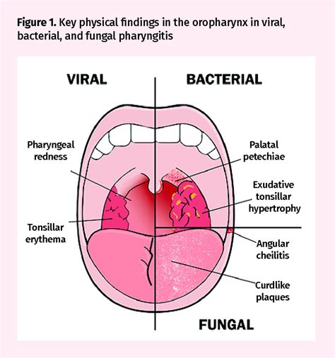 Pharyngitis Causes
