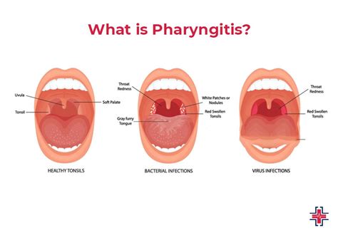 Pharyngitis Prevention
