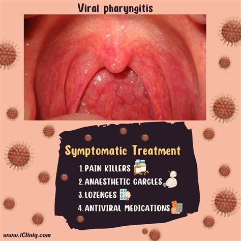 Pharyngitis Treatment