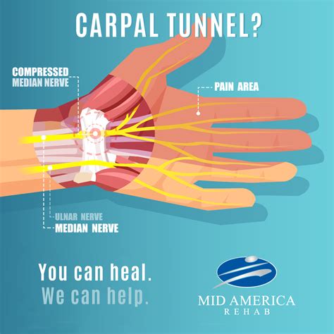 Physical Therapy for Carpal Tunnel Syndrome