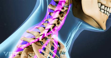 Physical Therapy for Neck Sprains