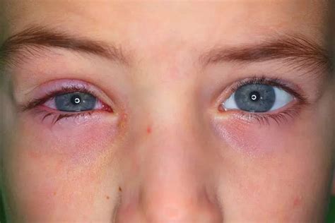 pink eye in infants symptoms