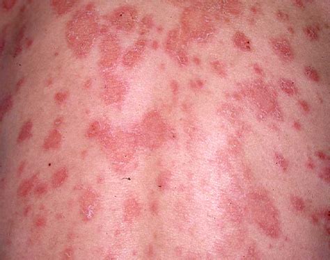 Pityriasis Rosea and Alternative Therapies