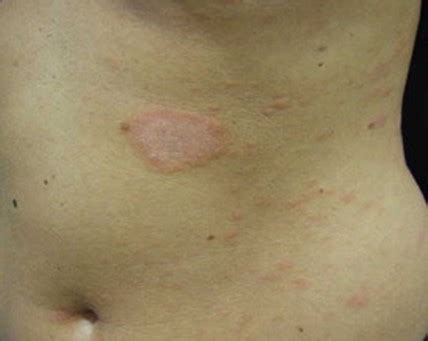 Pityriasis Rosea and Pregnancy