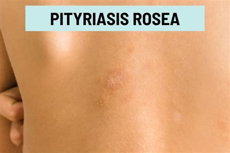 Pityriasis Rosea Complications