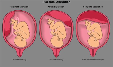 Placenta Rupture