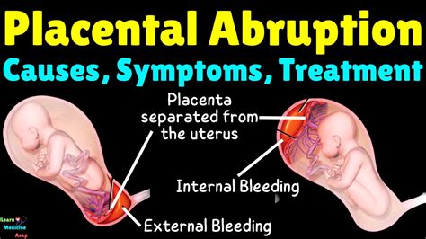Placenta Rupture Diagnosis