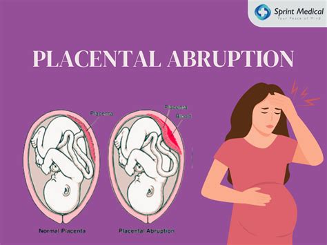 placental abruption conclusion