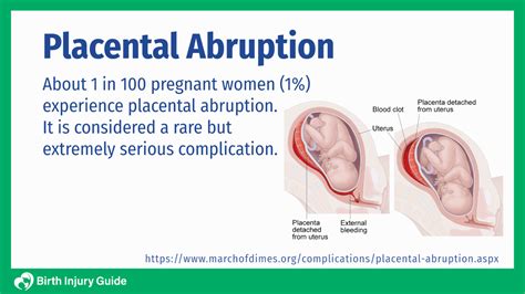 placental abruption diagnosis