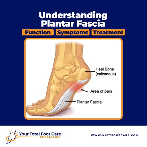 plantar fasciitis