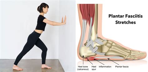 plantar fasciitis relief