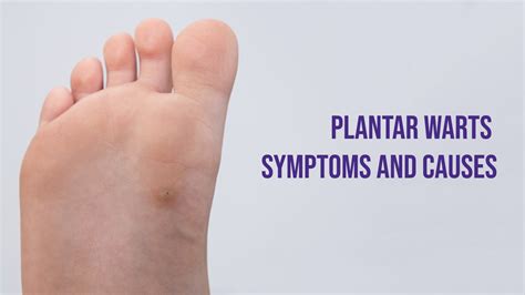 plantar wart conclusion