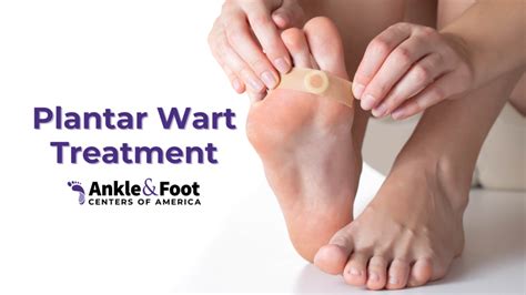 Plantar Wart Prevention