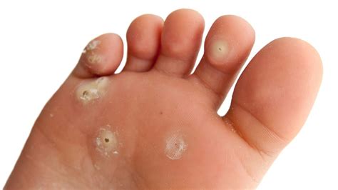Plantar Wart Removal