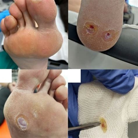 Plantar Wart Research