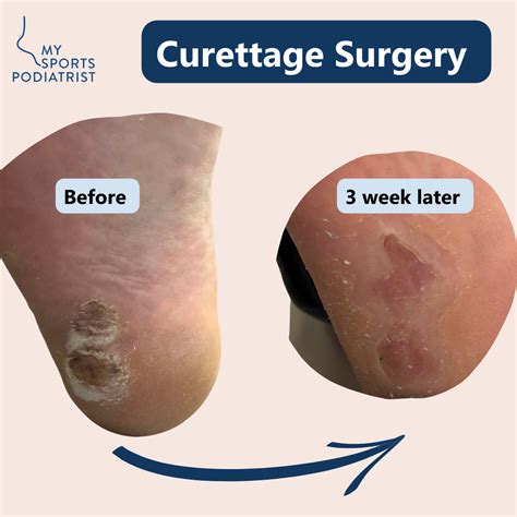 plantar wart surgical options