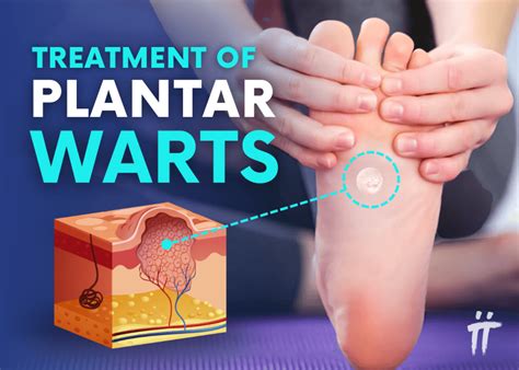 Plantar Wart Treatment