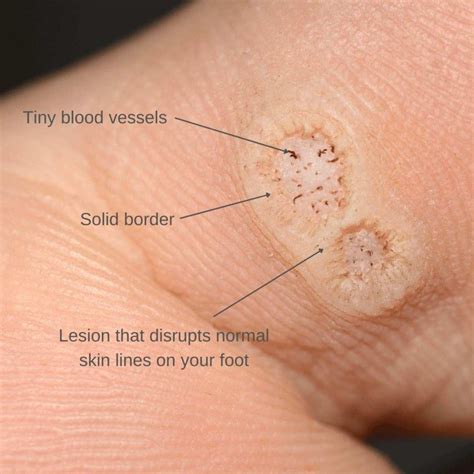 plantar warts