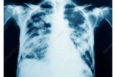 Pneumocystis Pneumonia PCP