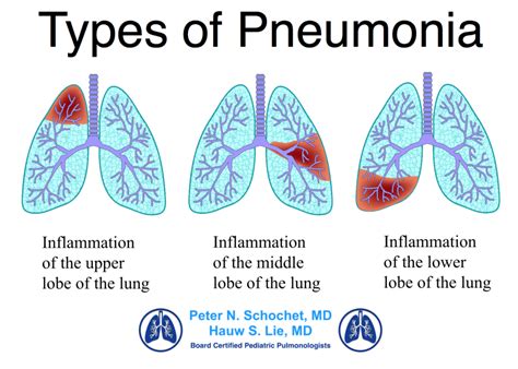 Pneumonia Types