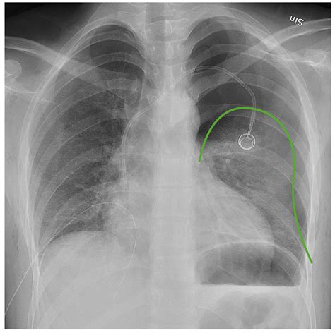 Pneumothorax
