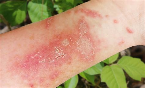 poison oak rash
