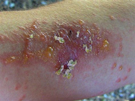 poison oak rash conclusion