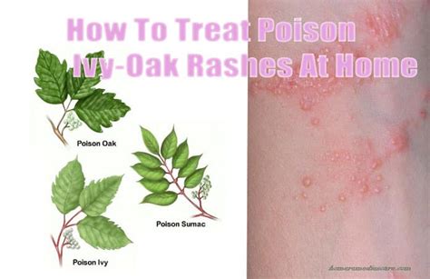 poison oak rash prevention